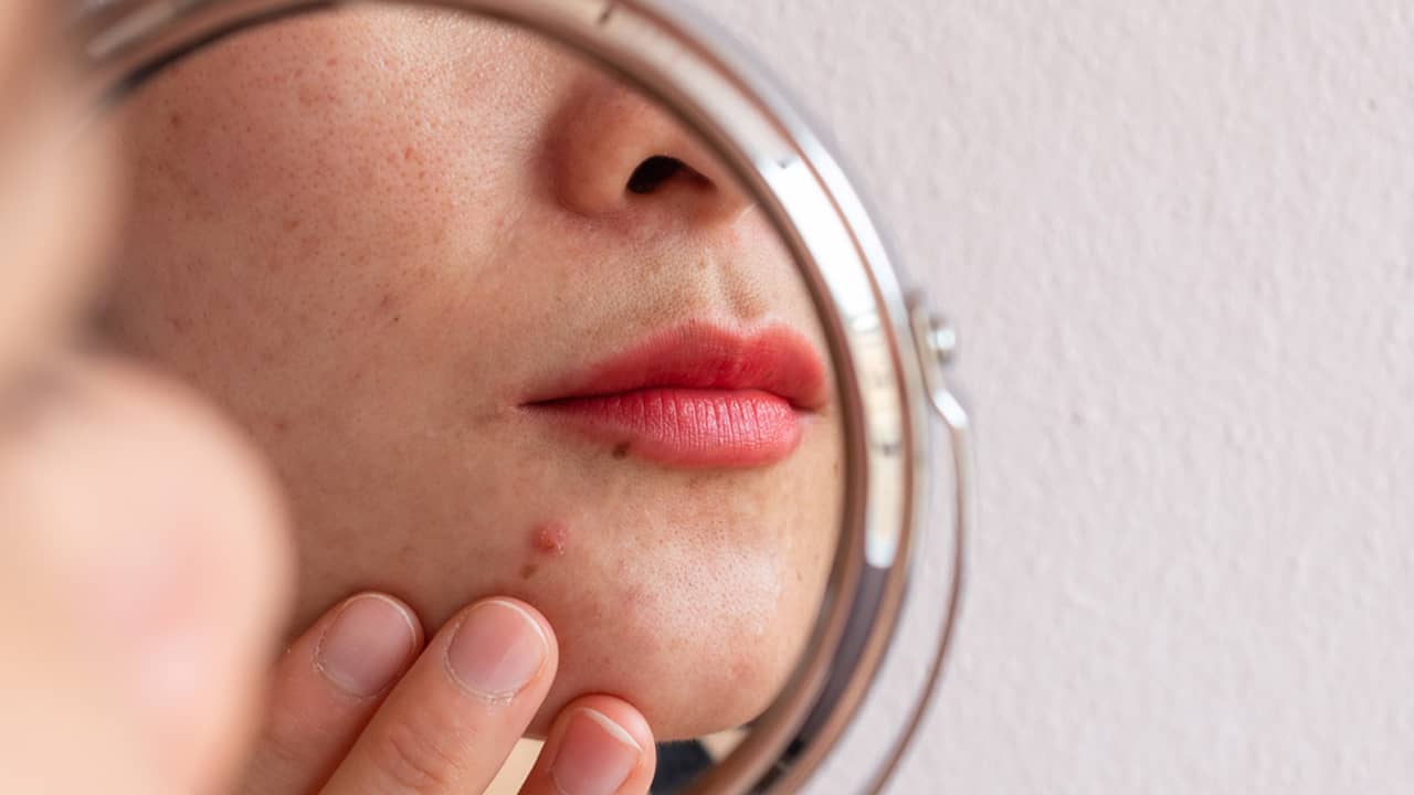 BioRePeel to transforming your skin