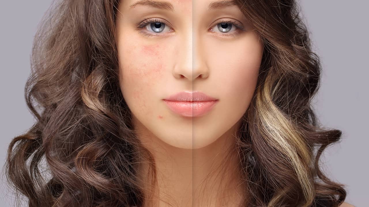 Peeling for acne at-home treatment by Mypeeling.com