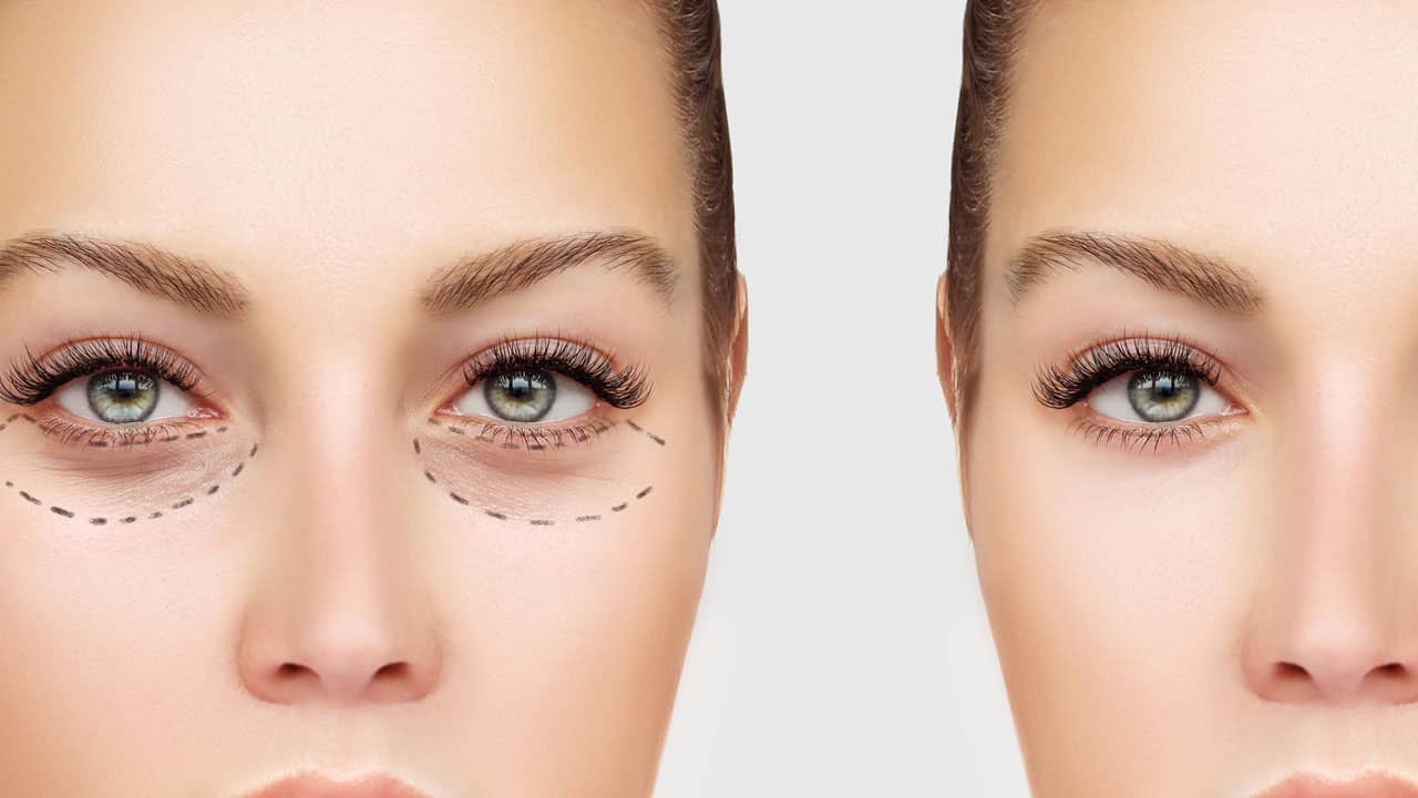 How peeling can help treat dark circles ?