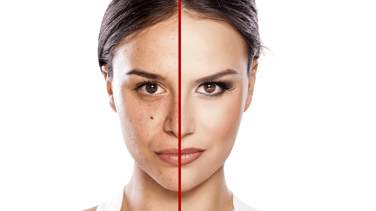 Discover radiant, spot-free skin with at-home pigment & dark spots peeling treatments
